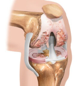 Semne de deformare a artrozei articulației încheieturii