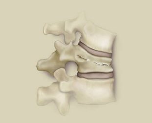 Una fessura della colonna vertebrale