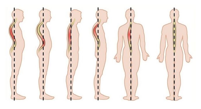 Disturbi posturali come causa di osteocondrosi toracica