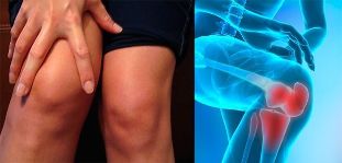 Il disagio e il gonfiore nella zona del ginocchio sono i primi sintomi dell'osteoartrosi