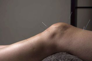 L'agopuntura promuove la riparazione del tessuto articolare